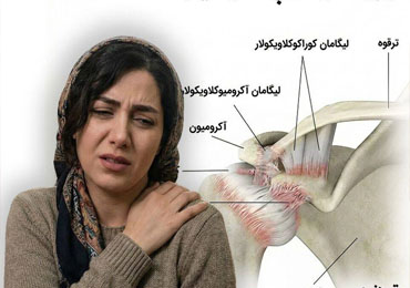علت اصلی شانه یخ زده چیست ؟؟ و برای درمان چکار کنیم؟؟
